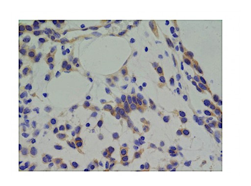 Researchers Find a Pathway That Leads to Resistance of Aggressive Brain Tumor Treatment