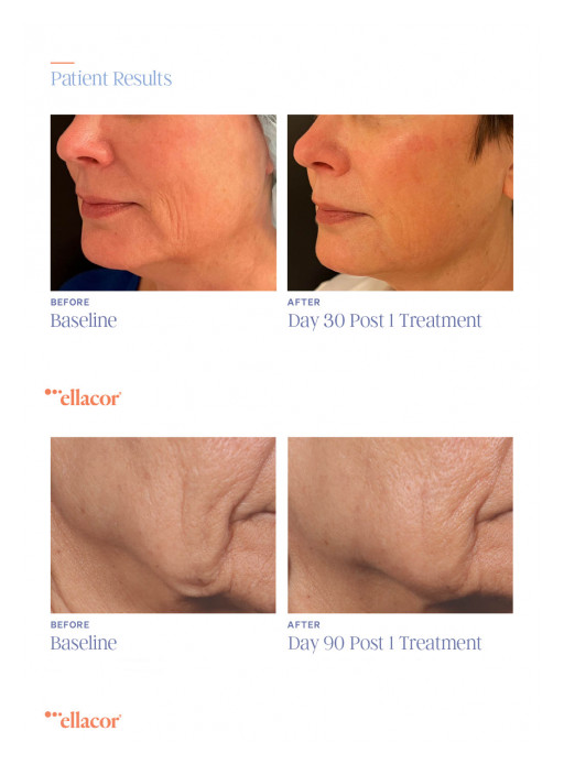 Acclaimed Beverly Hills Plastic Surgeon, Dr. Glenn Vallecillos M.D. F.A.C.S., Unveils Next-Generation Non-Surgical Facelift Solution