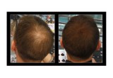 Allure HBF works for hair loss, hair transplant and root cover up.