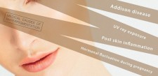 Causes of hyperpigmentation