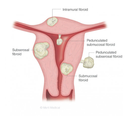 MIVA Medical Partners With Kansas City Radio Station KPRS to Educate Women About Uterine Fibroids