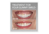 Example of Dr. Farnoosh's Signature Lip-Lowering Treatment